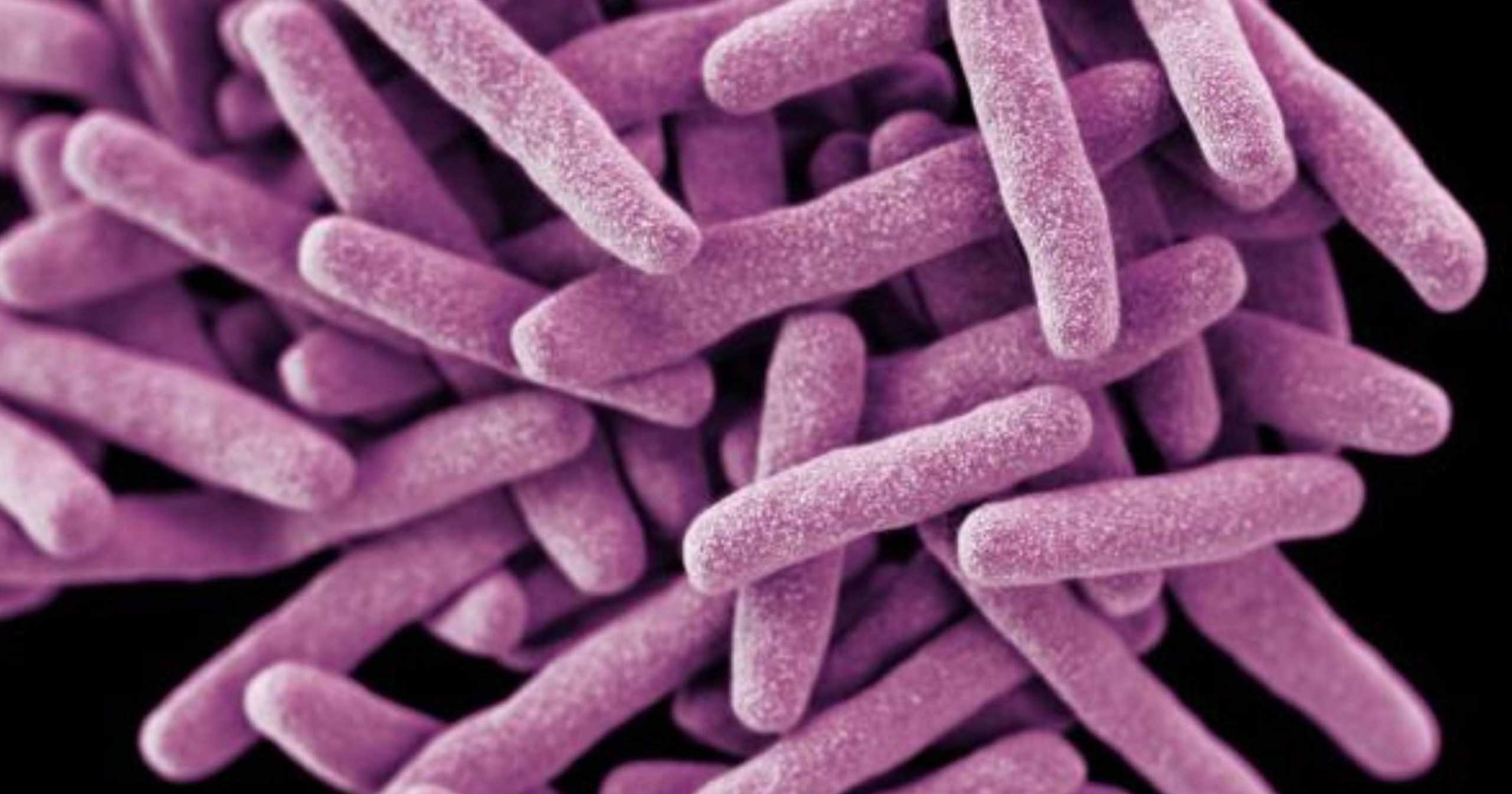 Tuberculosis: una enfermedad contagiosa grave pero curable en Axxis Hospital Quito